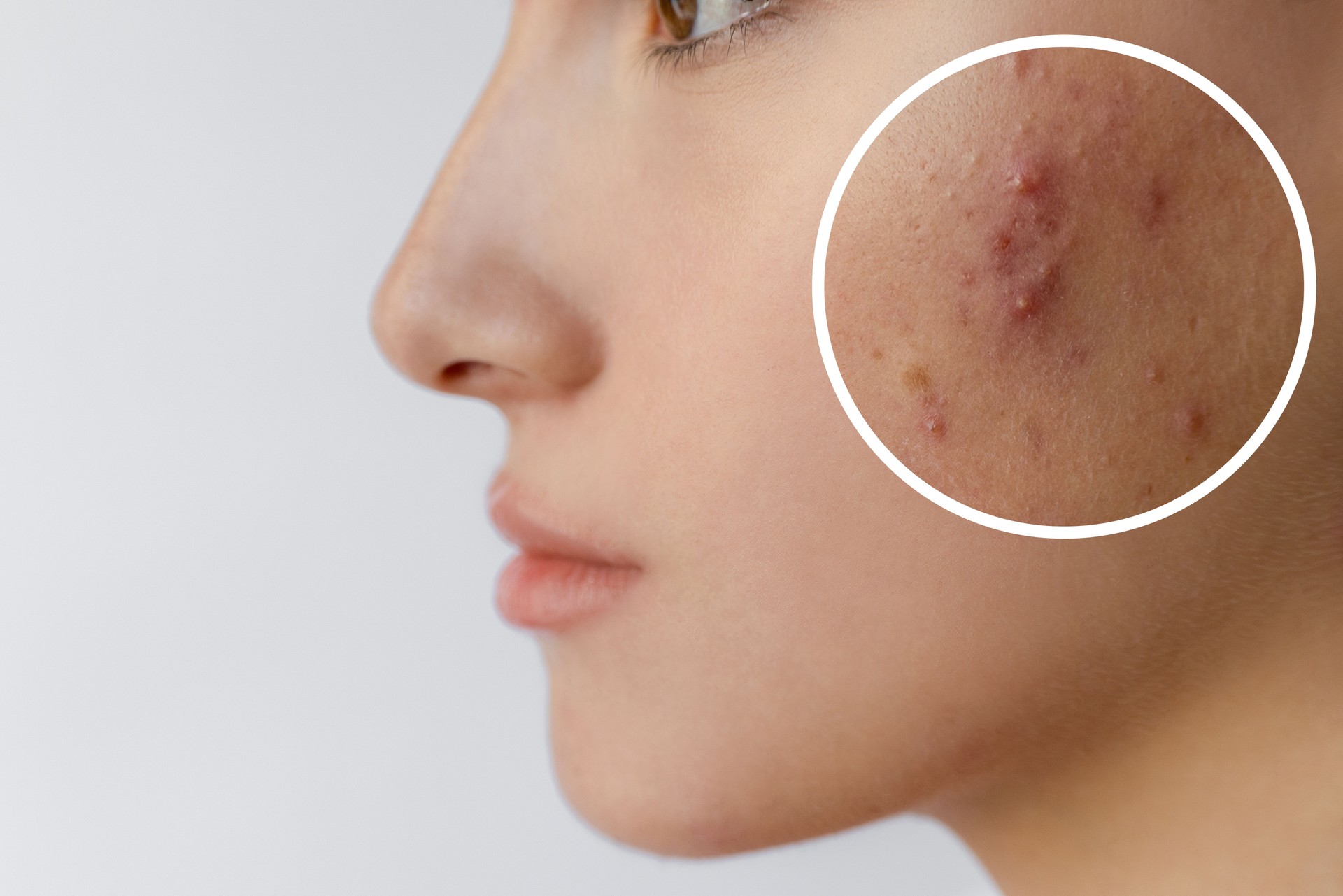 Young woman with acne