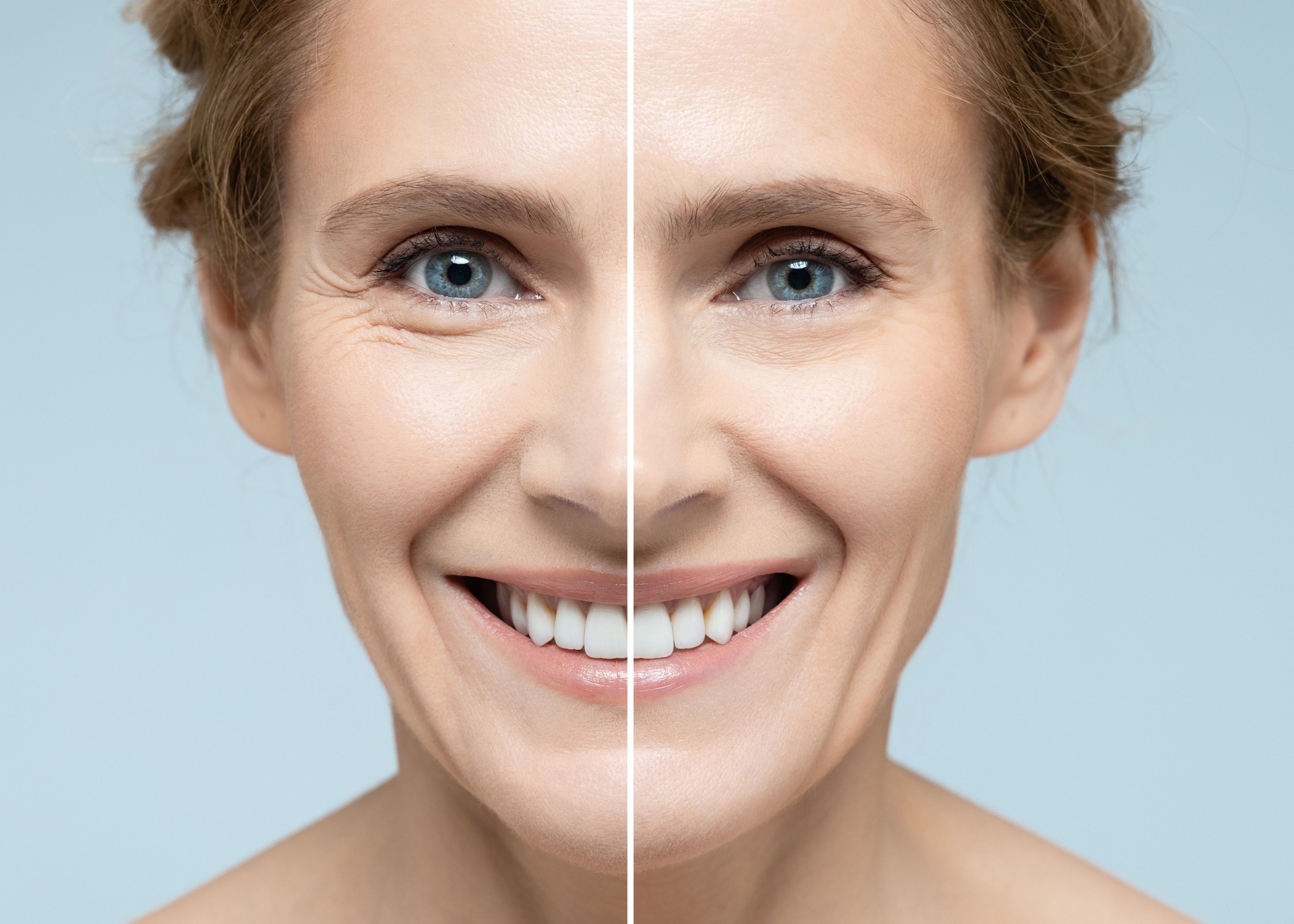 Woman's face before and after skin tightening and anti-aging procedures. Remove of wrinkles, nasolabial folds, skin rejuvenation procedure